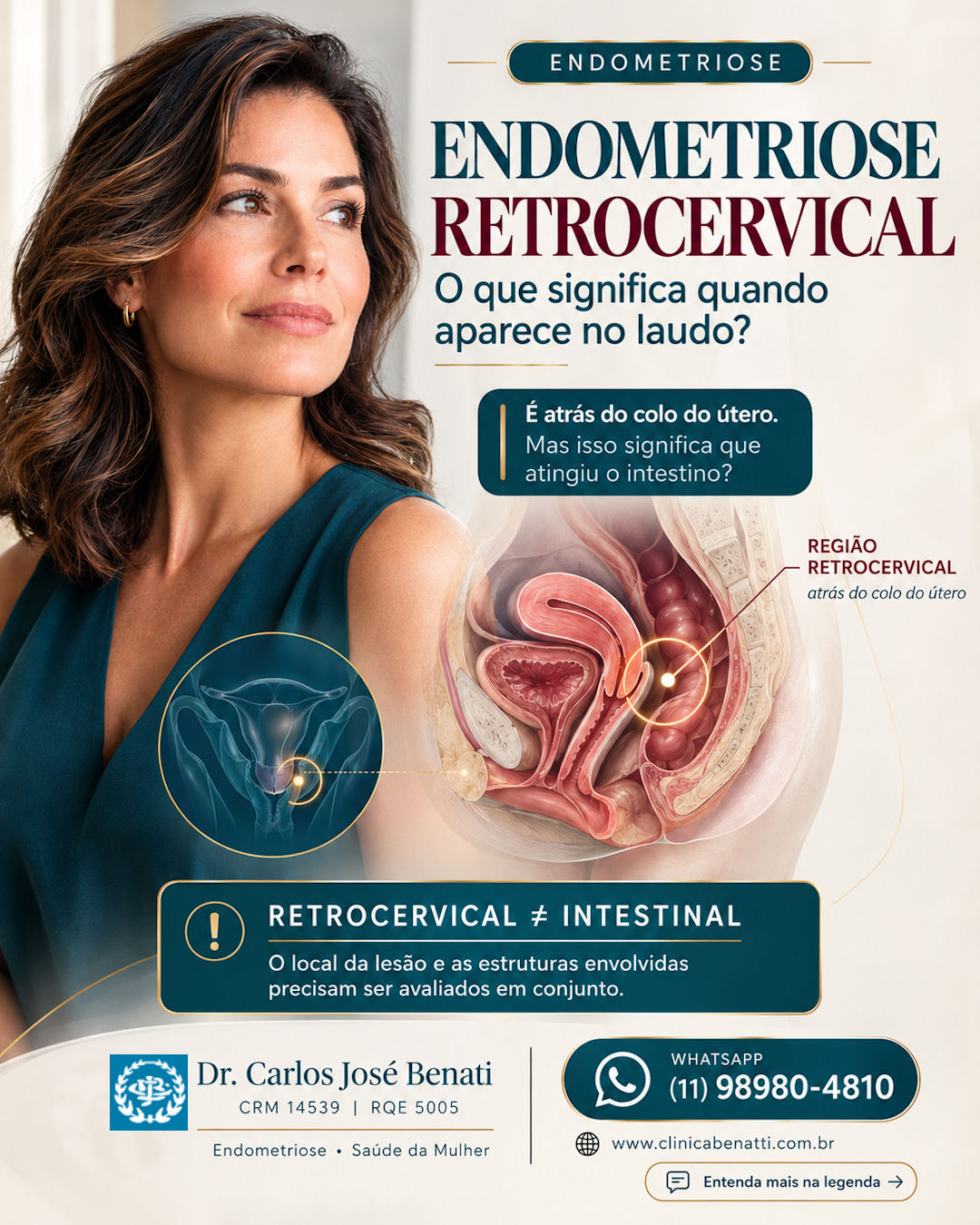 Endometriose retrocervical identificada em exame de imagem