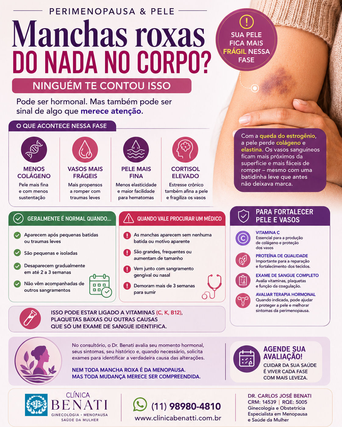 Manchas roxas e hematomas na pele durante a menopausa