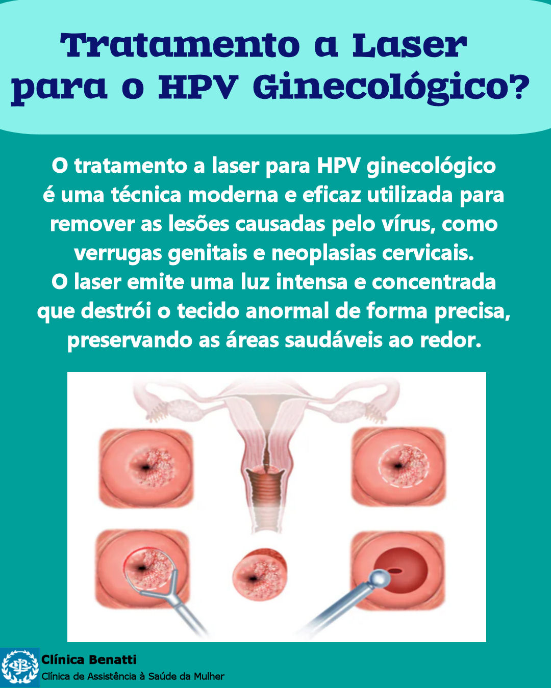 Tratamento a Laser para HPV Ginecológico